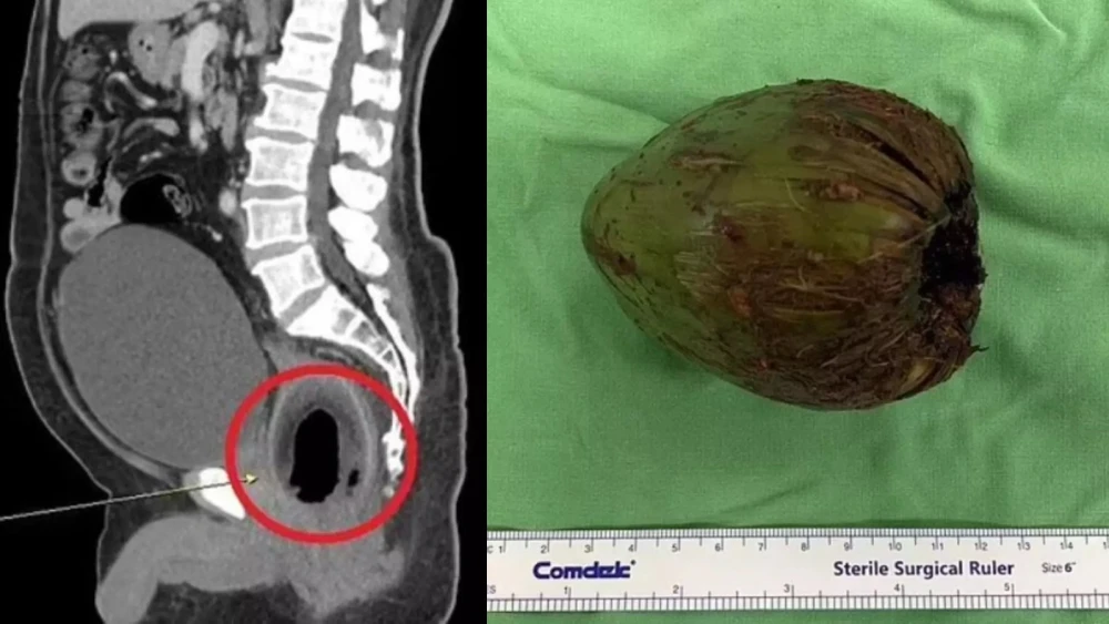Homem é operado após inserir coco de 9 centímetros do anvs para estimulação s3xual