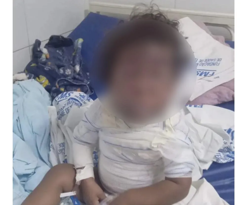 Criança tem corpo queimado em acidente doméstico no Piauí