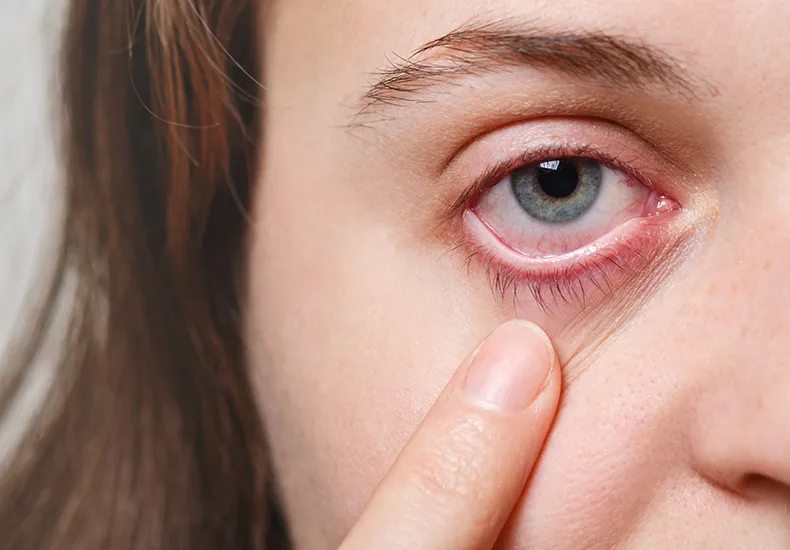 Altas temperaturas no verão aumentam o risco de infecções oculares