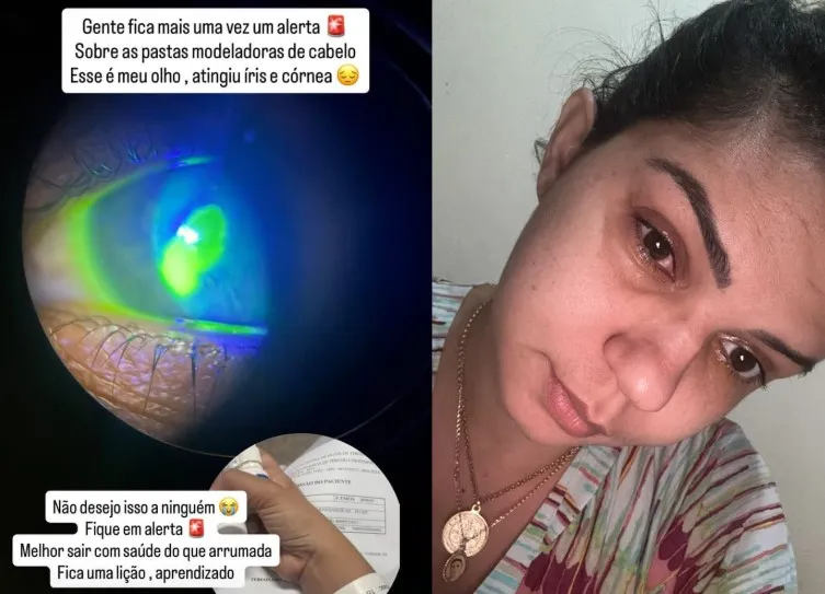 Mulheres relatam queimaduras nos olhos após uso de pomadas modeladoras no Piauí